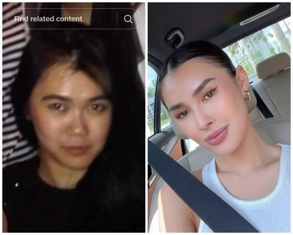 Michelle Halim sebelum dan sesudah operasi hidung © TikTok