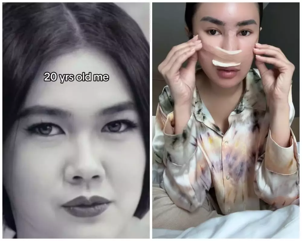Michelle Halim sebelum dan sesudah operasi hidung © TikTok