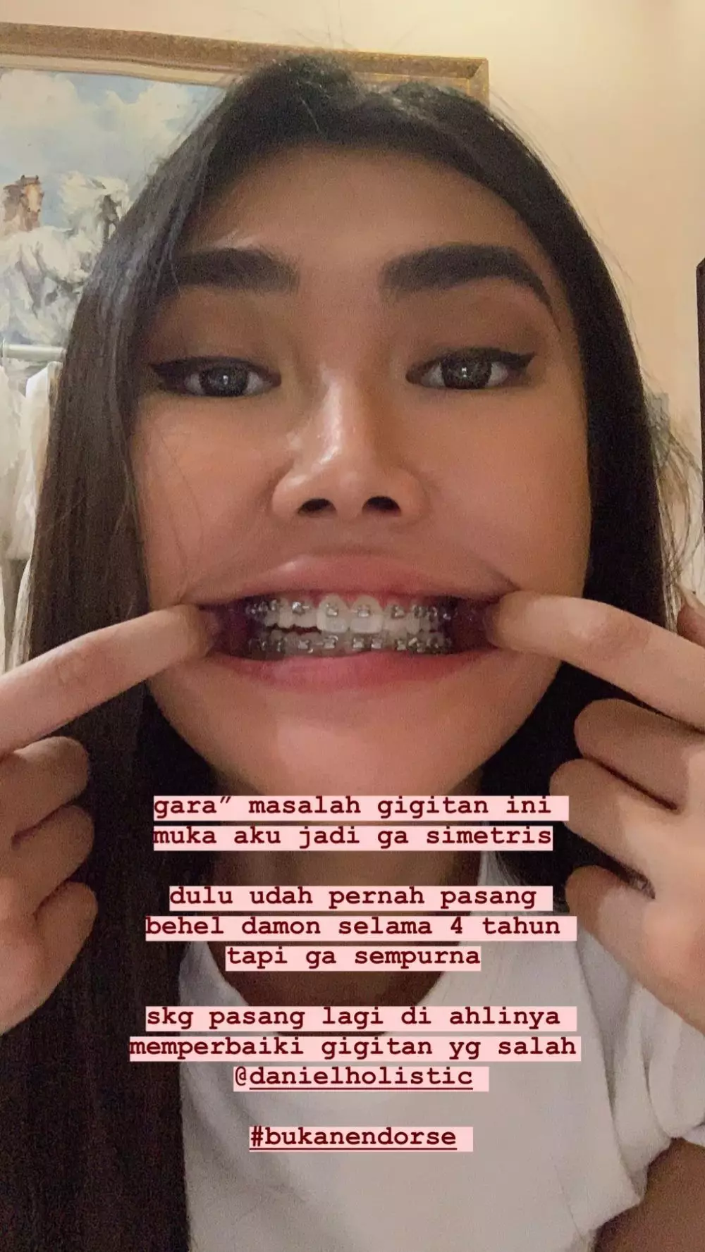 transformasi Michelle Halim sebelum dan sesudah pakai behel © 2025 brilio.net