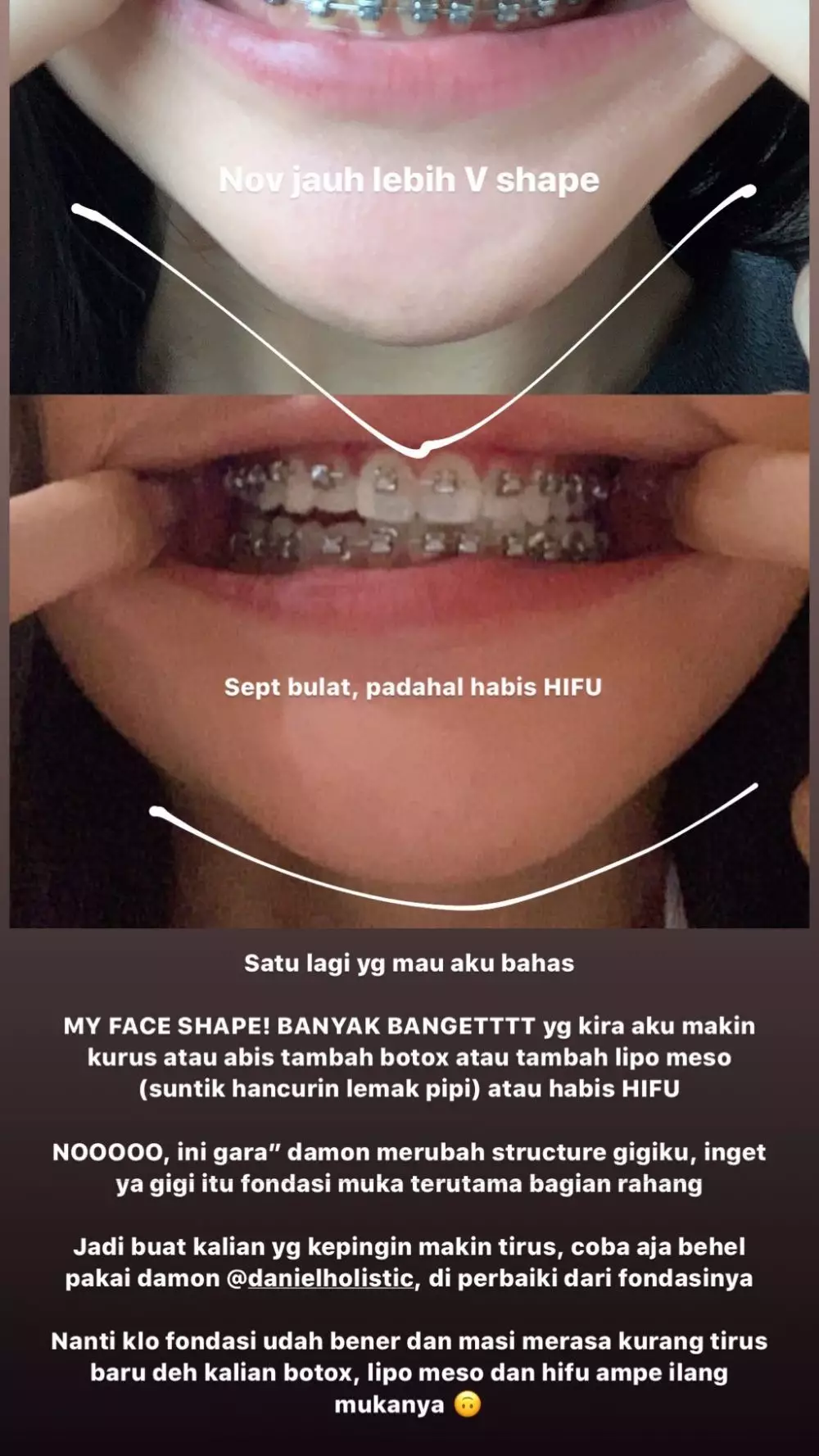 transformasi Michelle Halim sebelum dan sesudah pakai behel © 2025 brilio.net