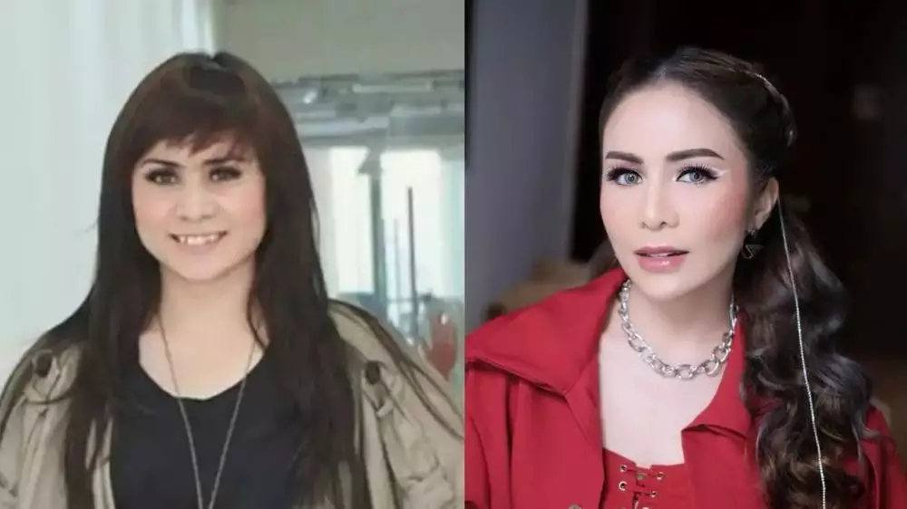 seleb sebelum dan setelah lakukan filler bibir (stok) © 2025 brilio.net seleb sebelum dan setelah lakukan filler bibir (stok) © 2025 brilio.net