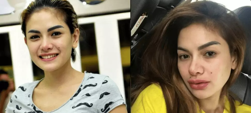 seleb sebelum dan setelah lakukan filler bibir (stok) © 2025 brilio.net seleb sebelum dan setelah lakukan filler bibir (stok) © 2025 brilio.net