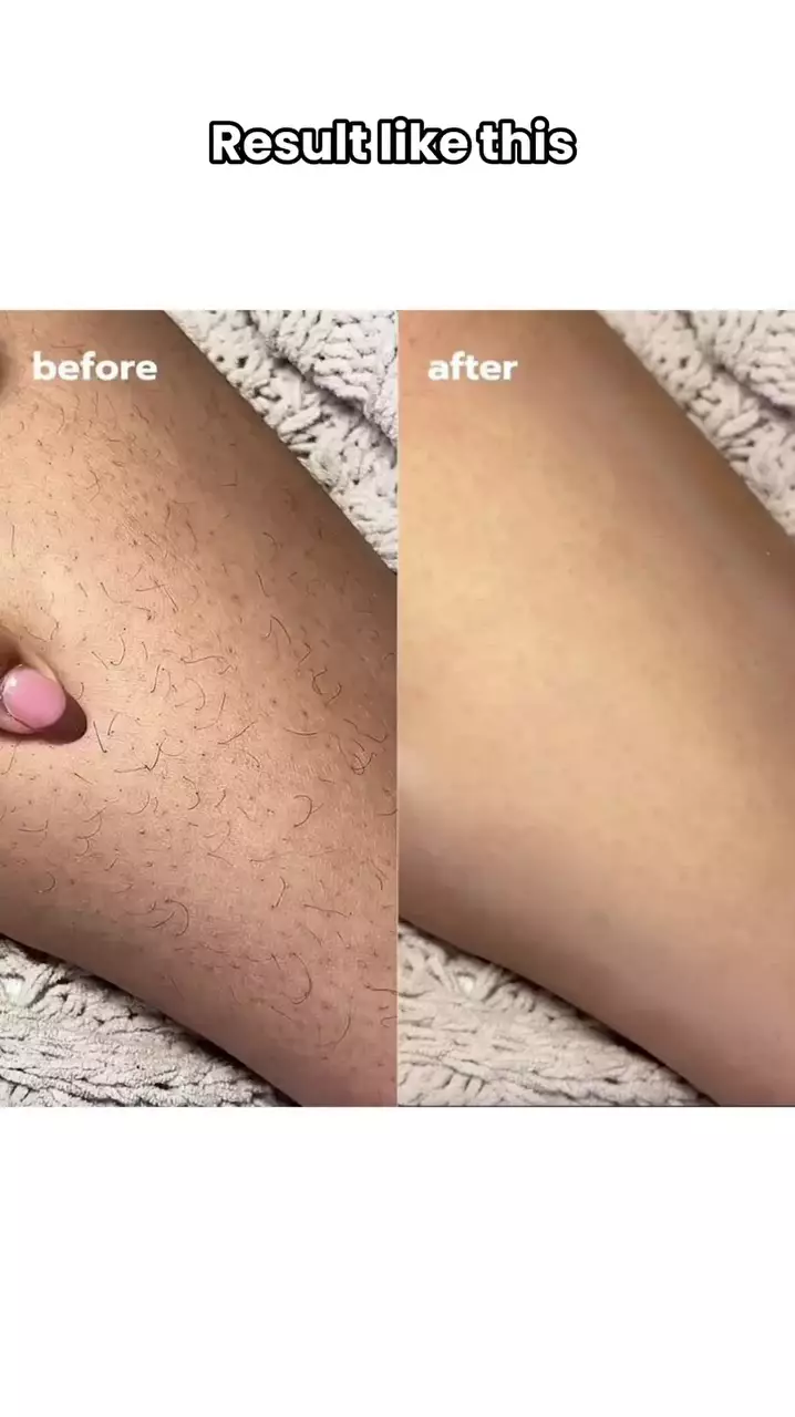 Cara menghilangkan strawberry skin © Instagram