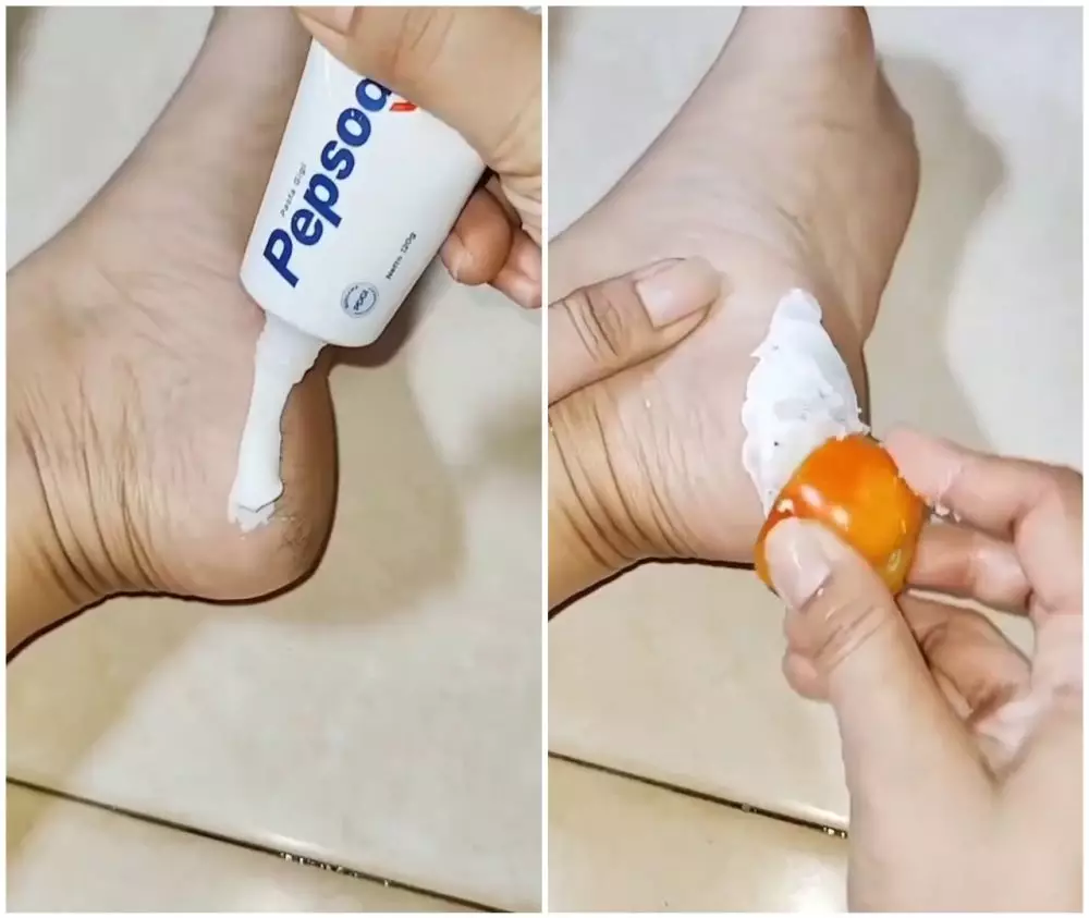 cara hilangkan kapalan di kaki © Instagram cara hilangkan kapalan di kaki © Instagram