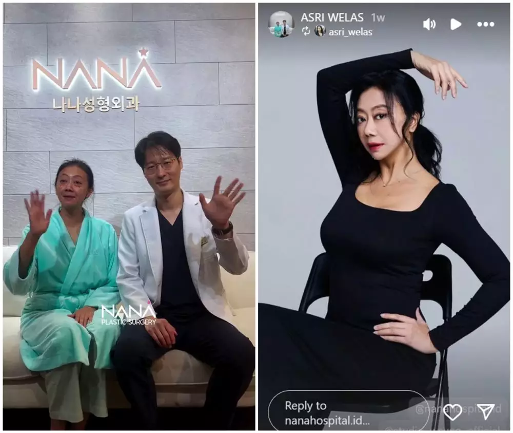 before-after Asri Welas © Instagram