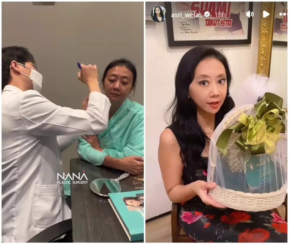 before-after Asri Welas © Instagram