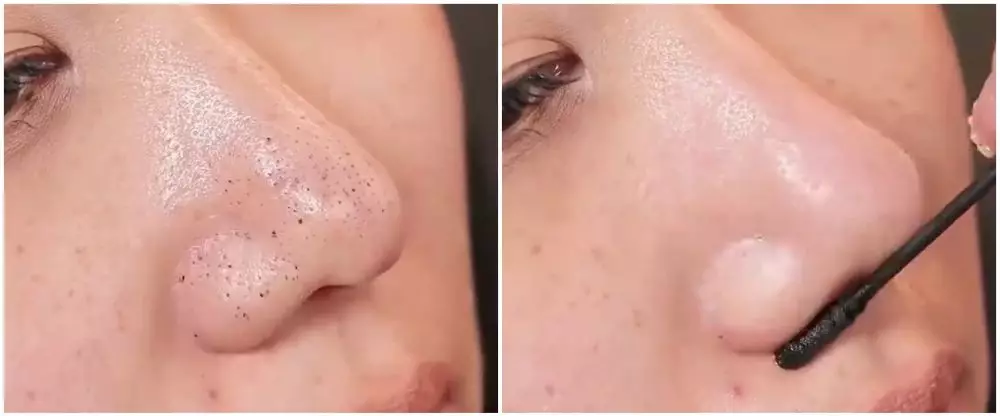 cara menghilangkan komedo hitam © Instagram