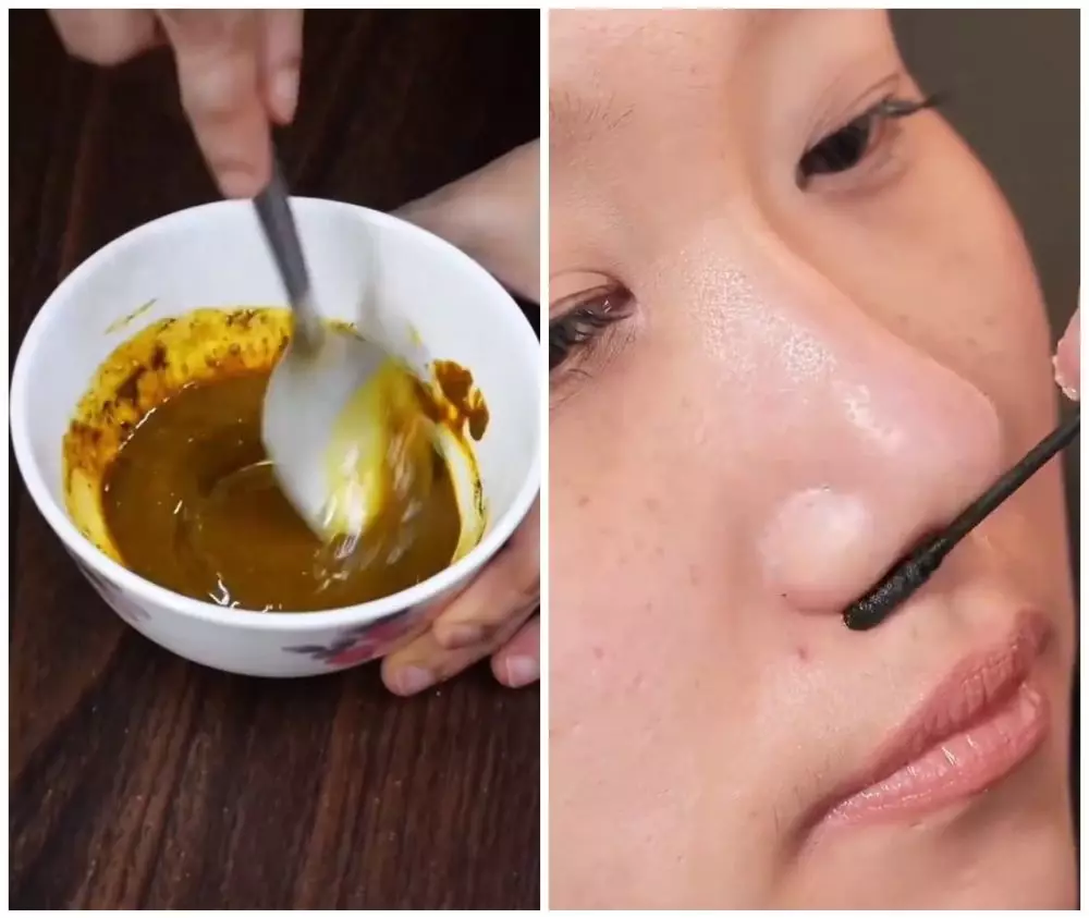 cara menghilangkan komedo hitam © Instagram