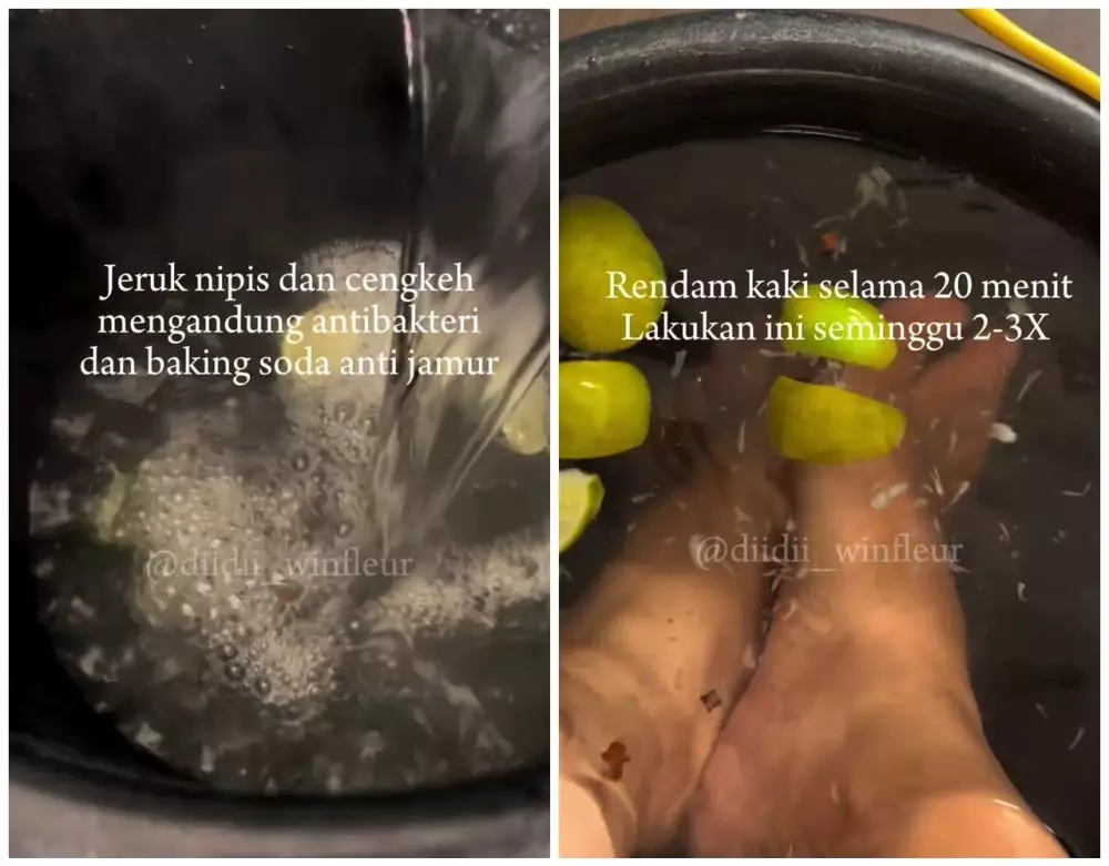 cara mengatasi infeksi jamur di kaki © Instagram 