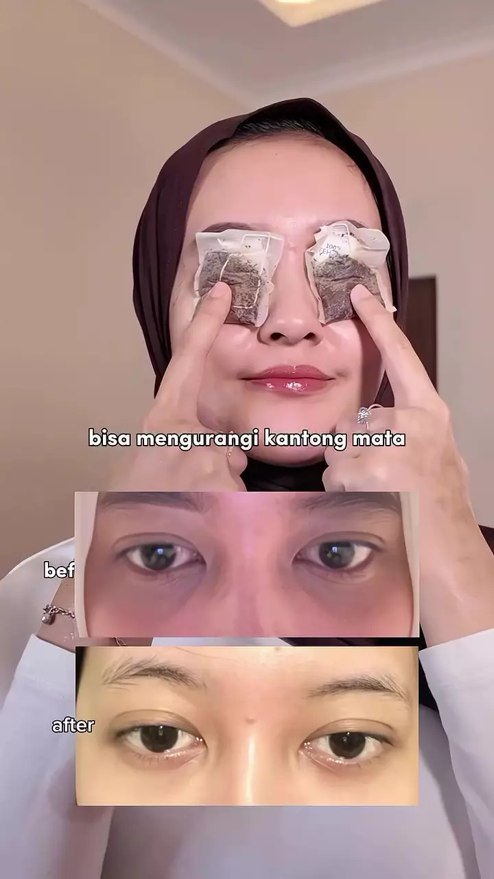 menghilangkan mata panda © Instagram