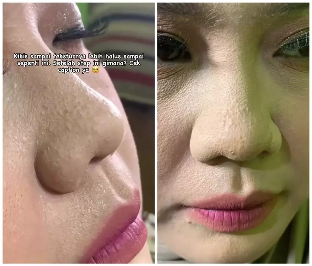 Complexion berlubang © Instagram Complexion berlubang © Instagram