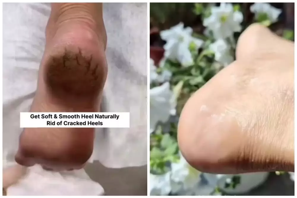 pecah-pecah bisa jadi mulus © Instagram 