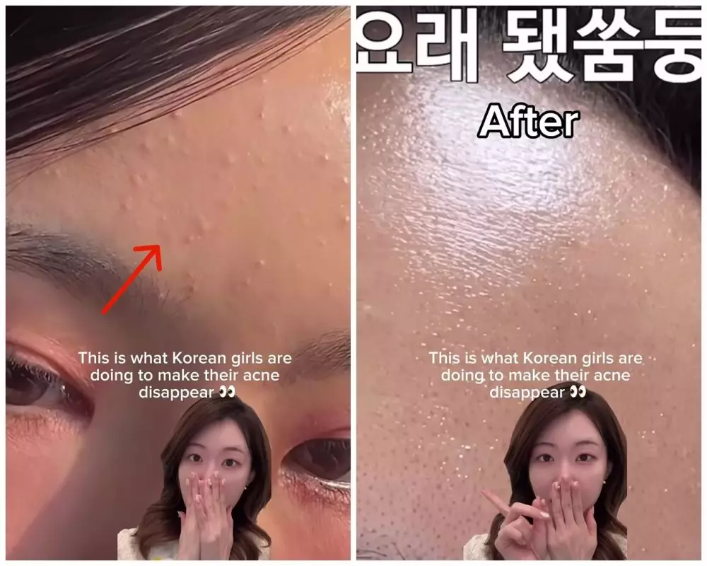 Cewek Korea ini bagikan rahasia hilangkan bruntusan © YouTube