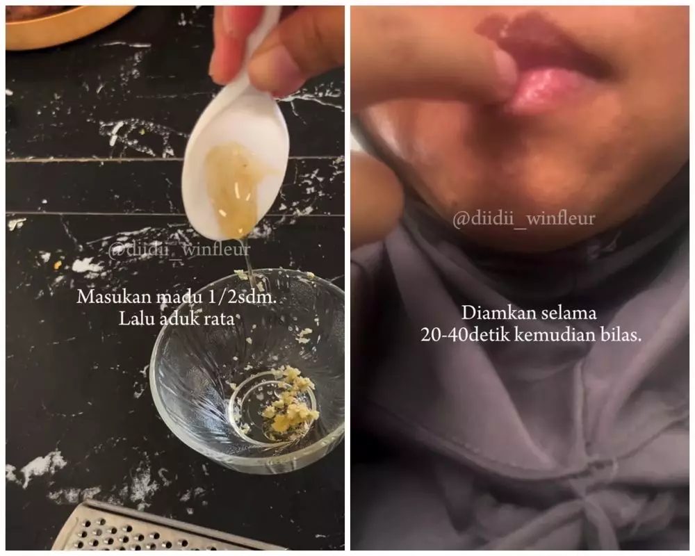 Bibir hitam, kering, dan sering pecah-pecah © Instagram Bibir hitam, kering, dan sering pecah-pecah © Instagram