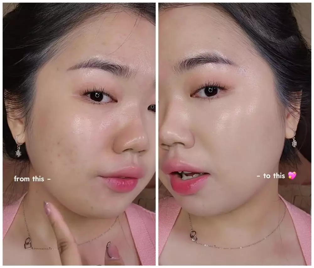 cara ampuh samarkan bekas jerawat © Instagram cara ampuh samarkan bekas jerawat © Instagram