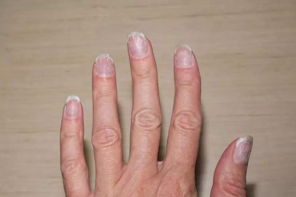 Kuku sering patah dan jamuran © Instagram