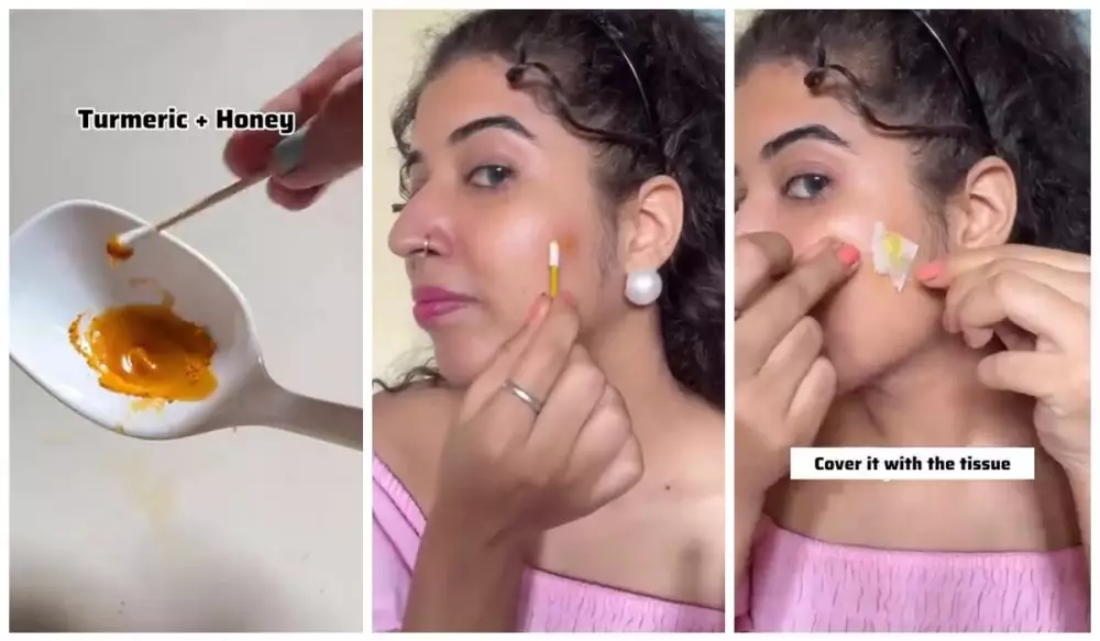 cara bikin acne patch © Instagram