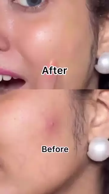 cara bikin acne patch © Instagram