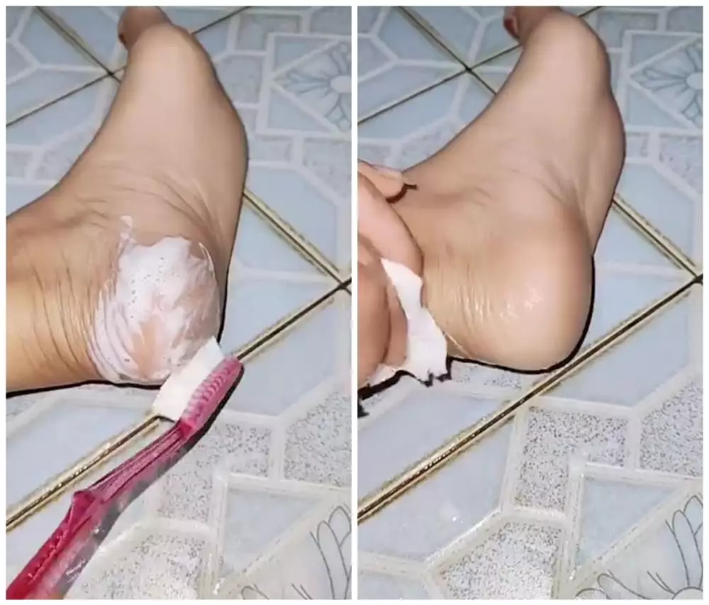 tumit pecah-pecah bisa kembali mulus © Instagram tumit pecah-pecah bisa kembali mulus © Instagram