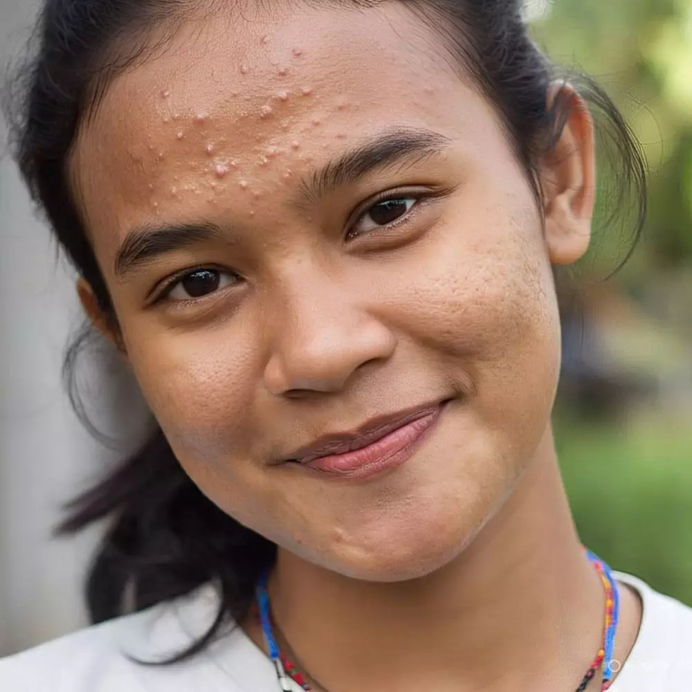 Perbedaan pori-pori besar dan komedo © 2025 brilio.net