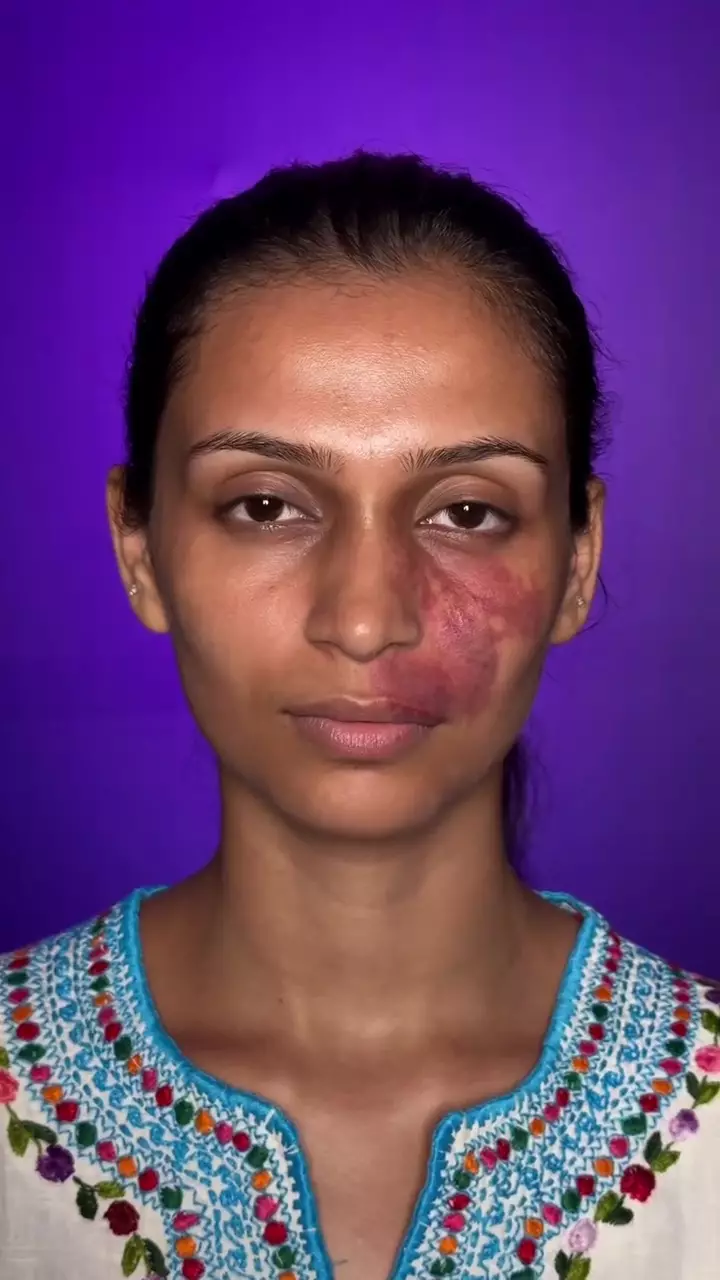 Bekas luka tertutup sempurna © Instagram 