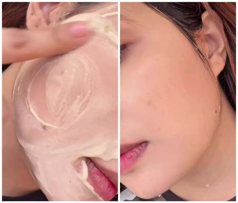 cara cepat menghilangkan jerawat aktif © Instagram  cara cepat menghilangkan jerawat aktif © Instagram