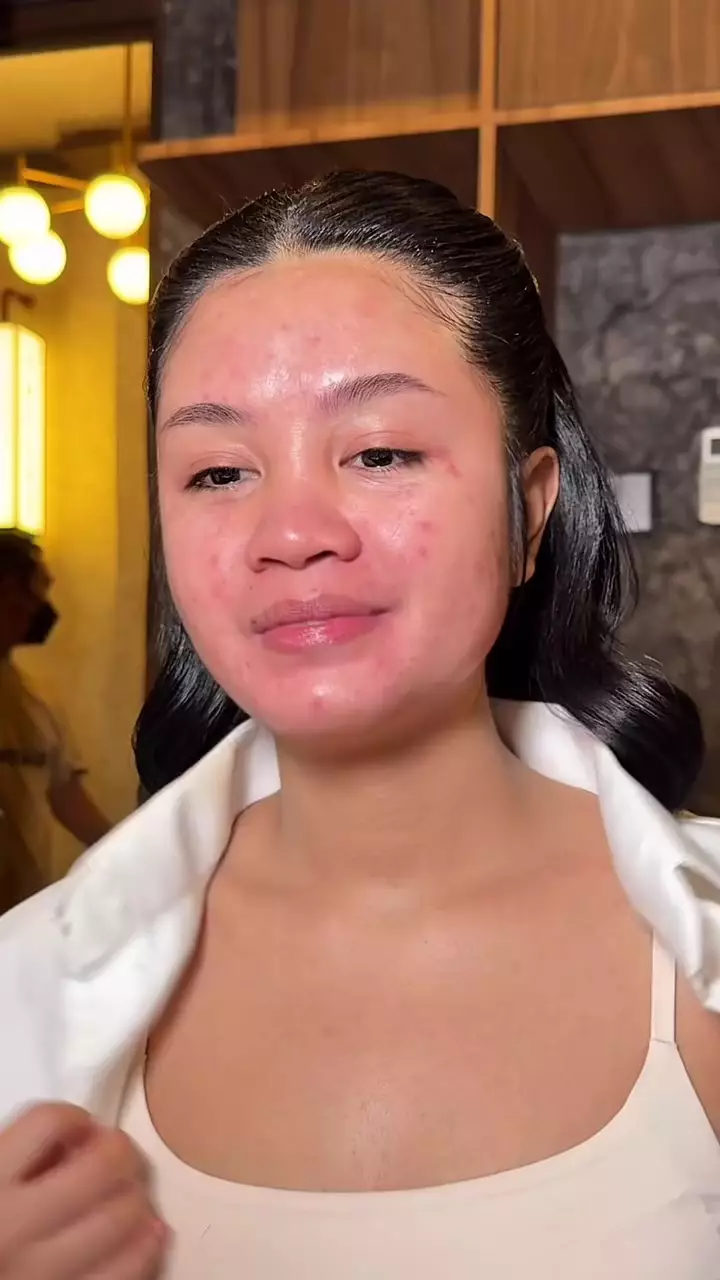 kemerahan karena bekas jerawat © Instagram