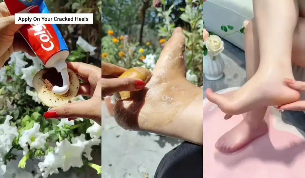 Tumit kapalan © Instagram Tumit kapalan © Instagram