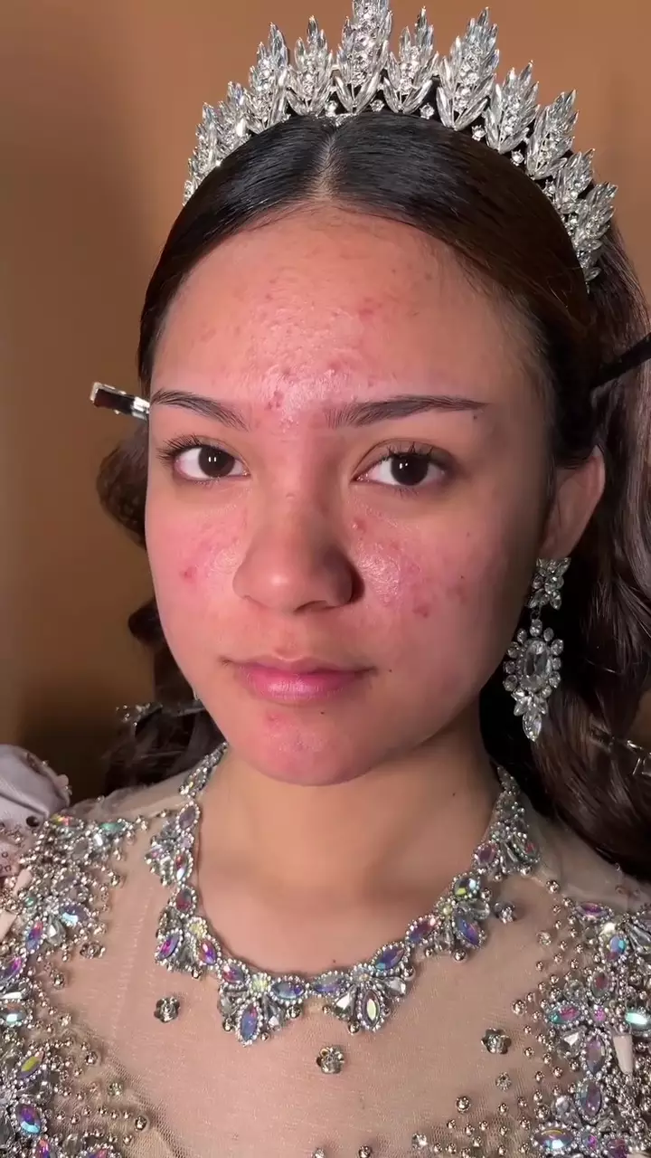 Punya jerawat aktif © Instagram