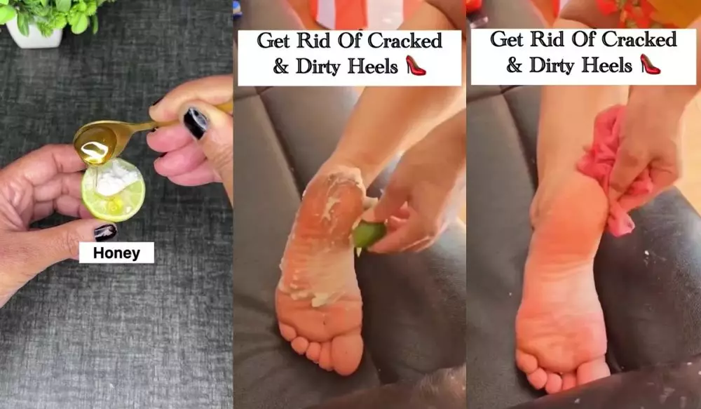 Tumit pecah-pecah bikin iritasi © Instagram