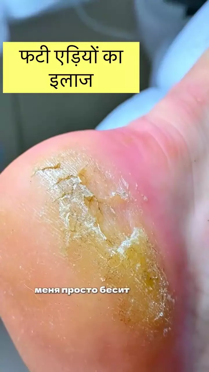 Cara bikin tumit kapalan © Instagram