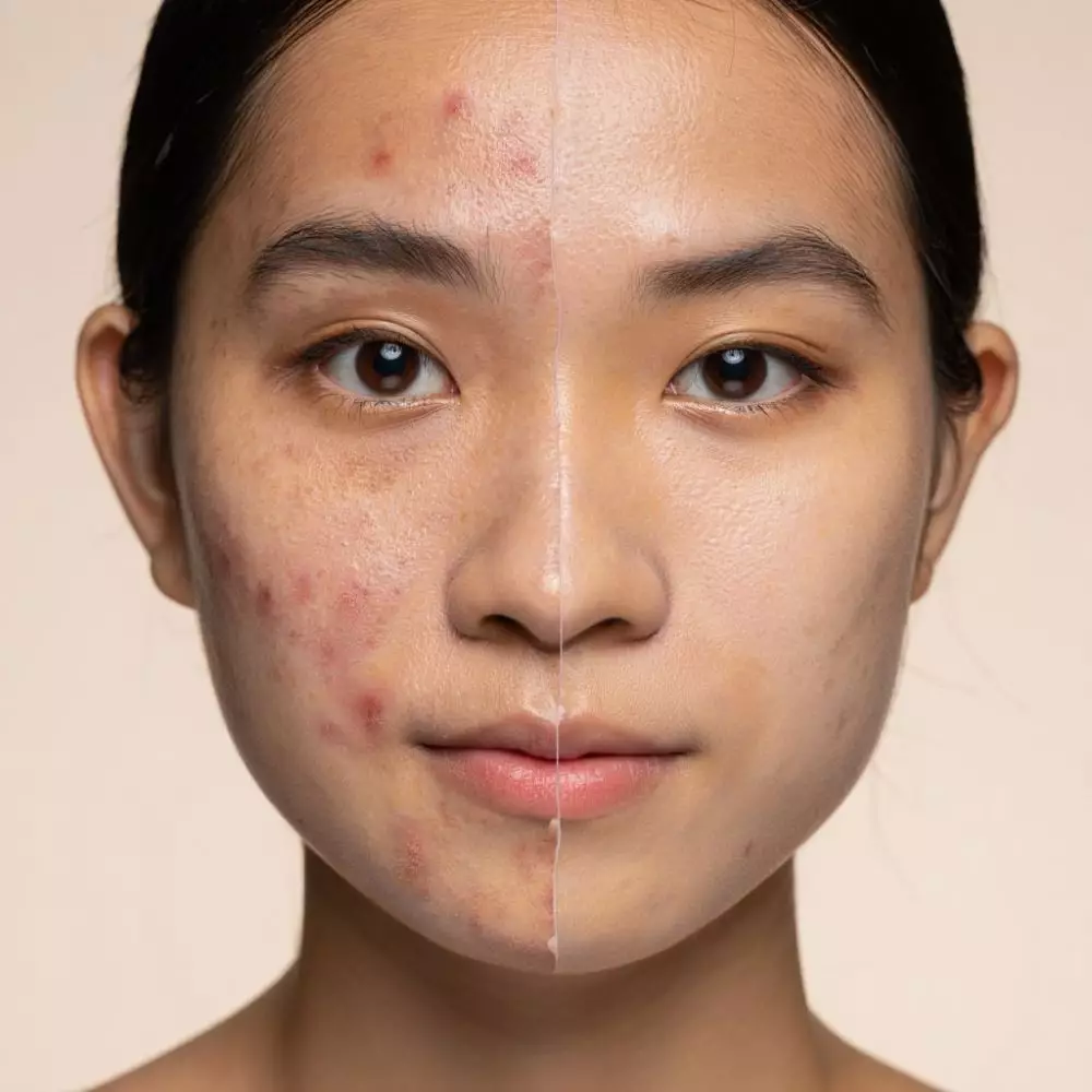 Rekomendasi BB cream terbaik untuk kulit berjerawat © 2025 brilio.net Rekomendasi BB cream terbaik untuk kulit berjerawat © 2025 brilio.net