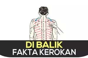 Fakta kerokan, berbahaya atau bermanfaat?