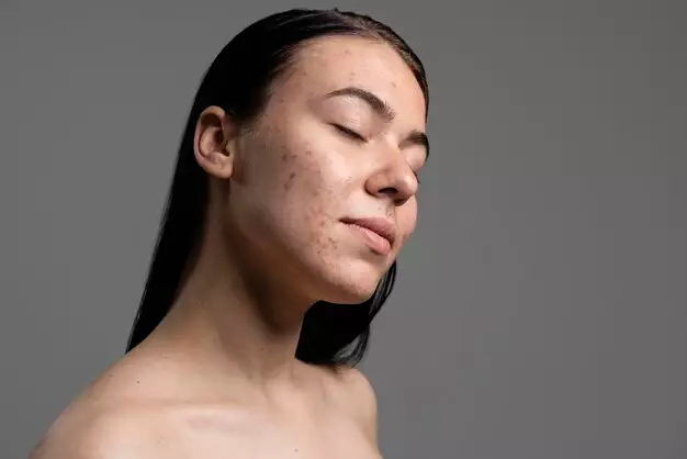penyebab flek hitam di wajah © penyebab flek hitam di wajah ©