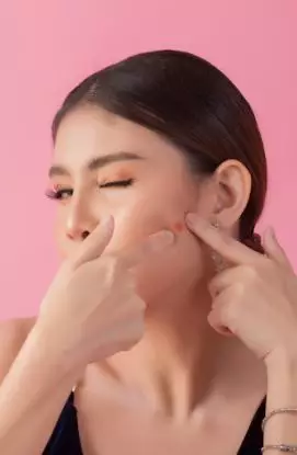 Mengenal milia pada wajah dan 7 cara mengatasinya Berbagai sumber Mengenal milia pada wajah dan 7 cara mengatasinya Berbagai sumber