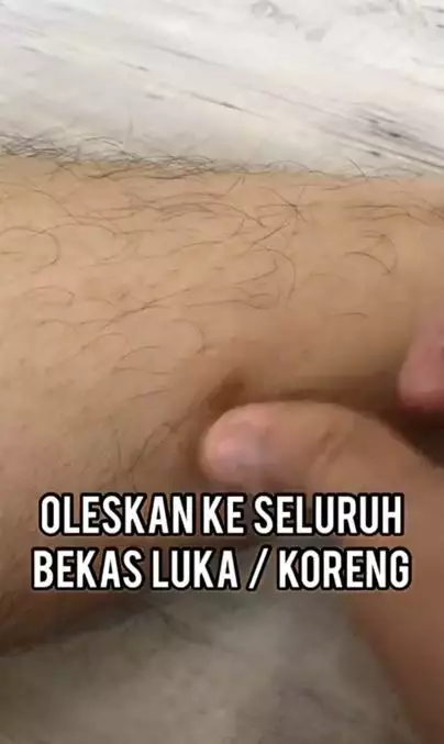 Tips menghilangkan bekas luka hanya pakai 2 bahan alami TikTok