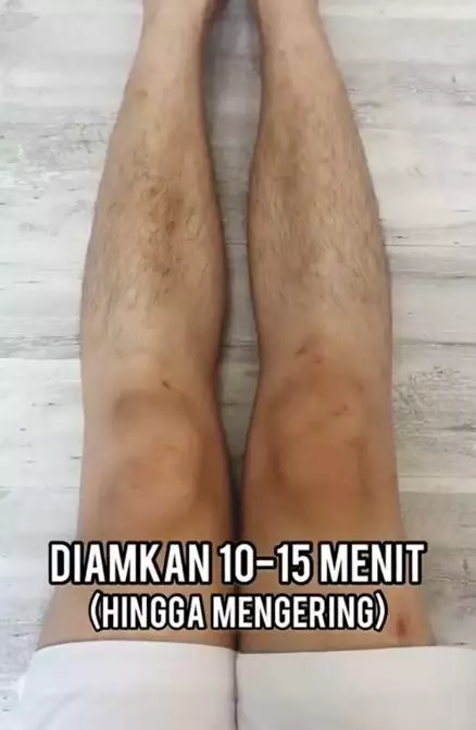 Tips menghilangkan bekas luka hanya pakai 2 bahan alami TikTok