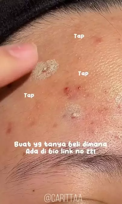 Trik samarkan jerawat matang menggunakan 2 produk makeup Berbagai sumber