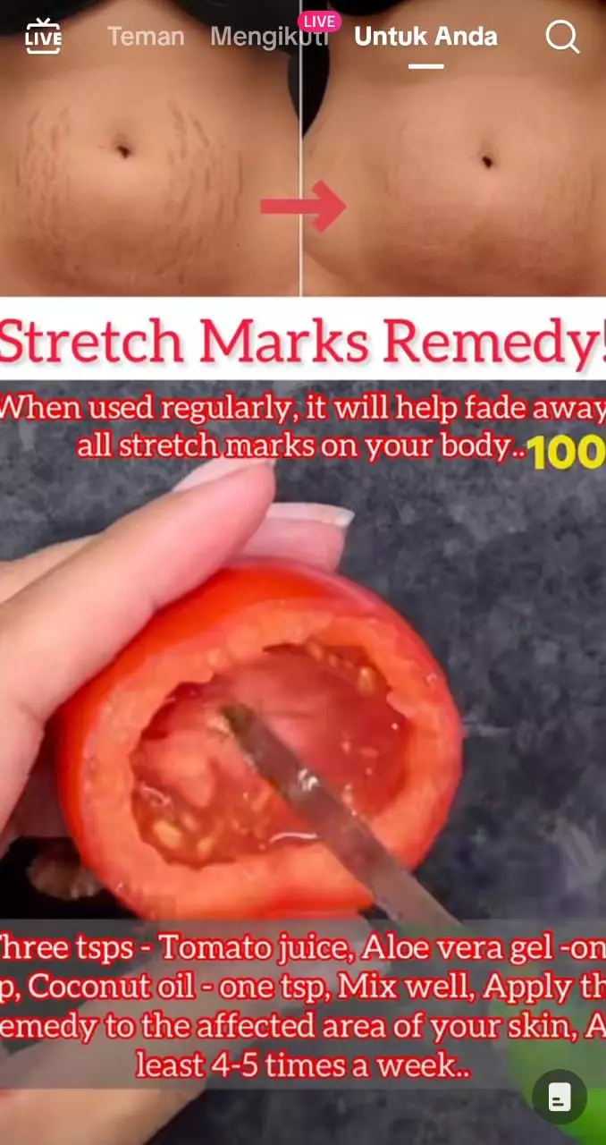 samarkan stretchmark pakai masker dari 3 bahan dapur © 2023 brilio.net samarkan stretchmark pakai masker dari 3 bahan dapur © 2023 brilio.net