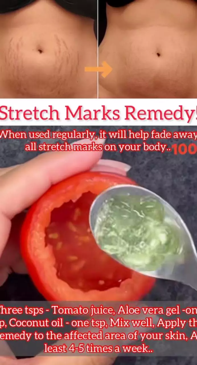 samarkan stretchmark pakai masker dari 3 bahan dapur © 2023 brilio.net samarkan stretchmark pakai masker dari 3 bahan dapur © 2023 brilio.net