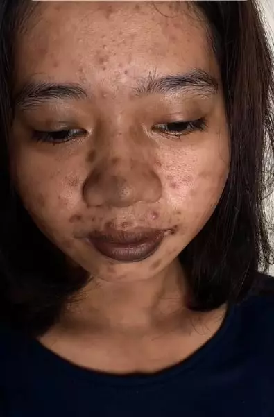 Transformasi makeup wajah wanita penuh jerawat berbagai sumber Transformasi makeup wajah wanita penuh jerawat berbagai sumber