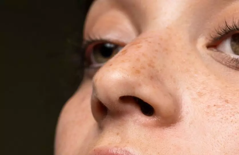 menghilangkan flek hitam di wajah berbagai sumber menghilangkan flek hitam di wajah berbagai sumber