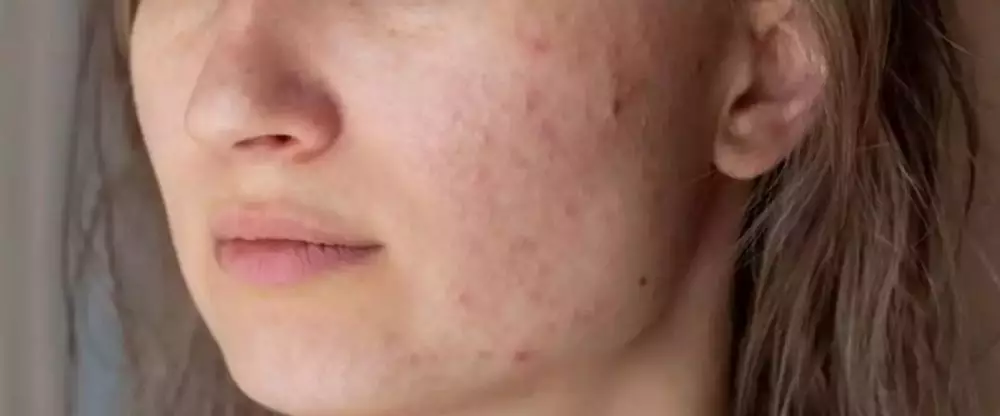 13 Cara mengatasi jerawat meradang freepik.com 13 Cara mengatasi jerawat meradang freepik.com