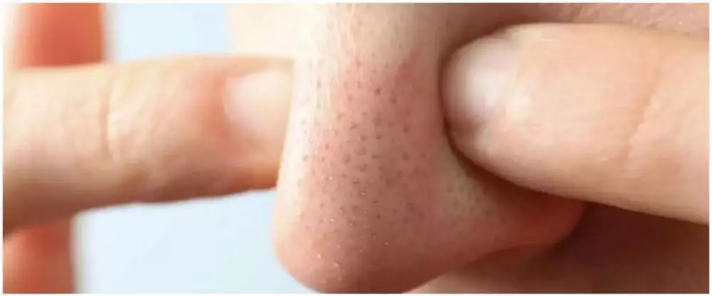 Cara menghilangkan komedo pakai bahan alami Berbagai sumber