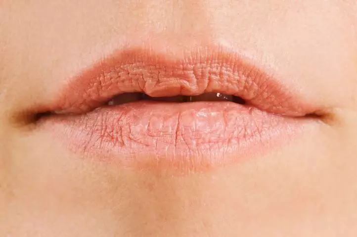 cara mengatasi bibir kering pecah-pecah berbagai sumber