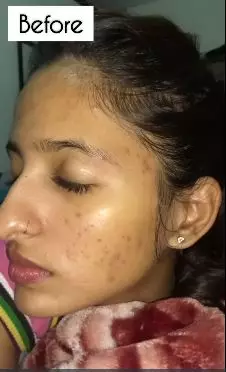 cara hilangkan flek hitam di pipi berbagai sumber cara hilangkan flek hitam di pipi berbagai sumber