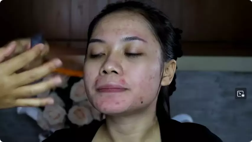 sulap wajah penuh jerawat jadi tampak glowing berbagai sumber sulap wajah penuh jerawat jadi tampak glowing berbagai sumber