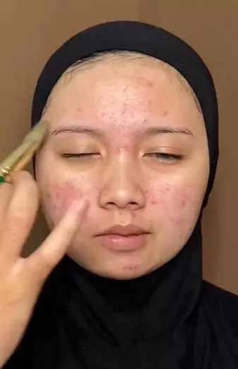 Wanita wajah berjerawat simpel bikin melongo TikTok
