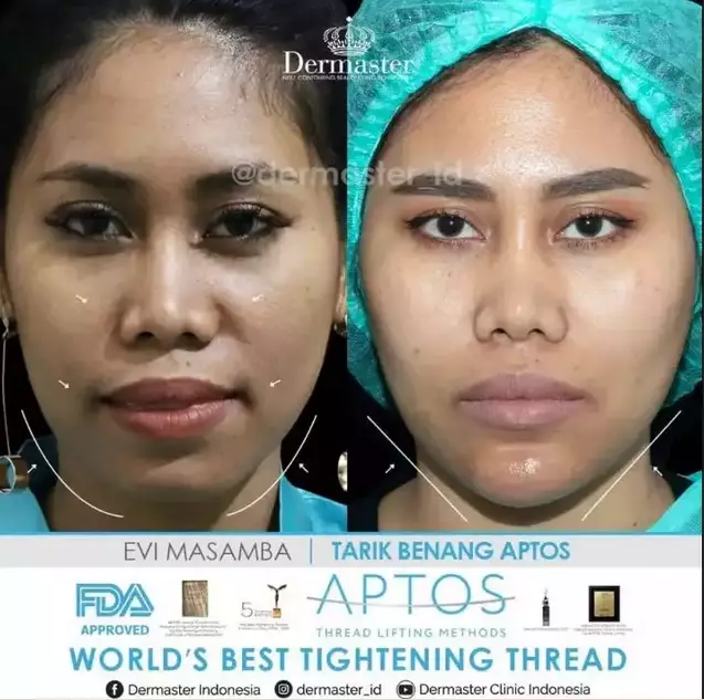 Sebelum dan sesudah tanam benang berbagai sumber Sebelum dan sesudah tanam benang berbagai sumber