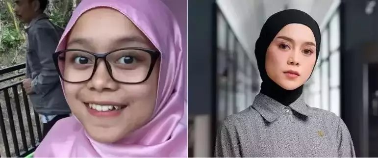 Sebelum dan sesudah tanam benang berbagai sumber Sebelum dan sesudah tanam benang berbagai sumber